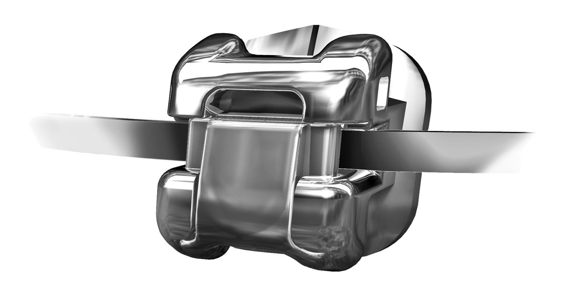 bung mắc cài khi niềng